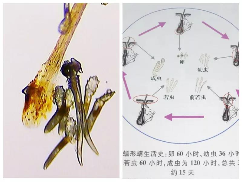 远大医药治疗蠕形螨睑缘炎产品在中国澳门获批上市