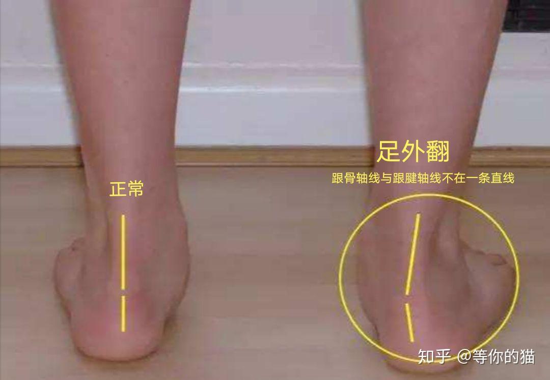 威高骨科获得发明专利授权：“一种用于跟骨置换的定制跟骨假体及制造方法”