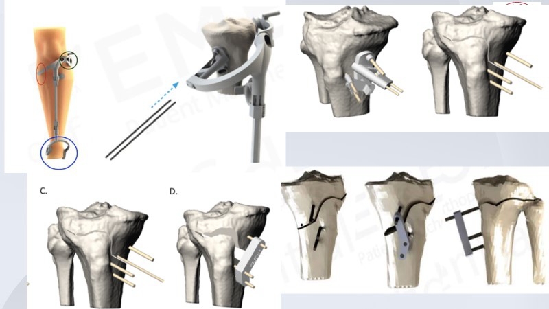 春立医疗获得发明专利授权：“一种仿生型假体截骨定位导板”
